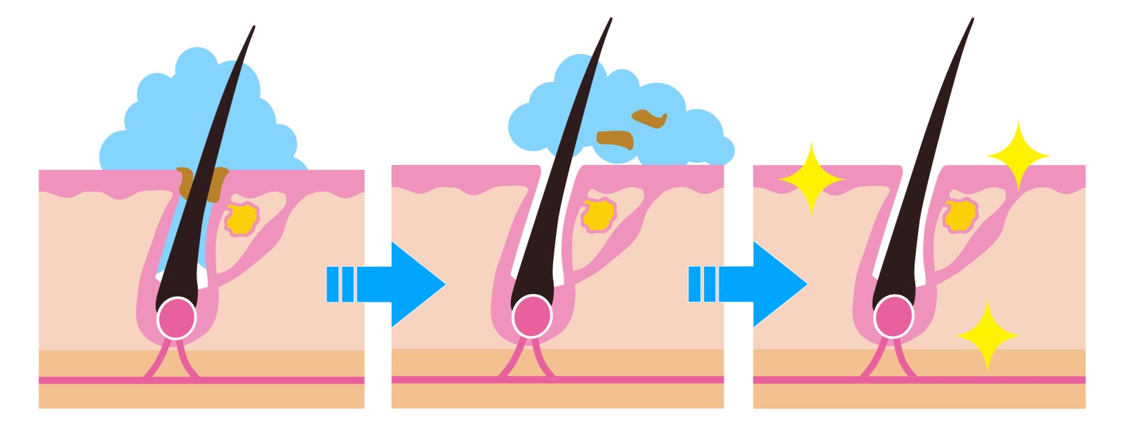毛穴洗浄の図